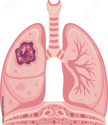 Illustration of human lungs showing a cancerous tumor in one lobe.