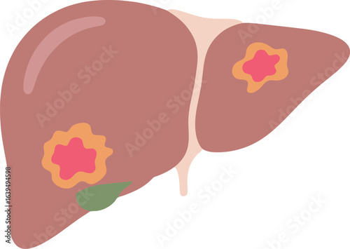 Illustration of a human liver showing cancerous tumors and gallbladder.