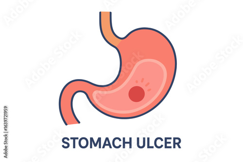 Stomach ulcer illustration in flat design style with pink color stomach ulcer diagram