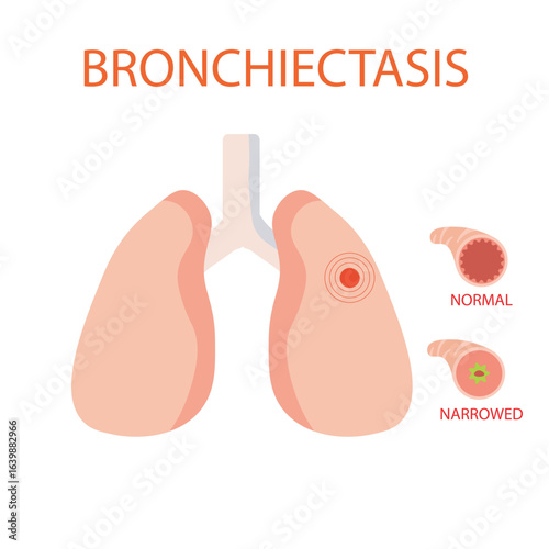 Bronchitis vector illustration showing lungs icon key symptoms like cough, mucus, fatigue, chest discomfort; also highlights similar diseases such as asthma and pneumonia