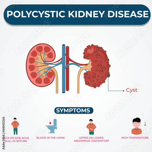 Polycystic Kidney Disease Causes Symptoms and Treatment Options