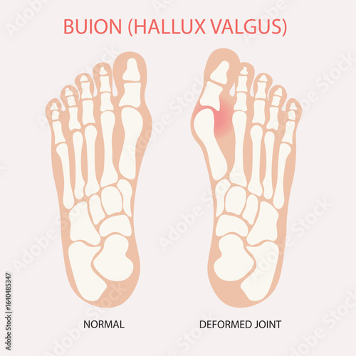 Medical vector illustration of Bunion (Hallux Valgus) showing big toe deformity, pain, swelling, redness; similar to gout, arthritis, hammertoe. feet icon