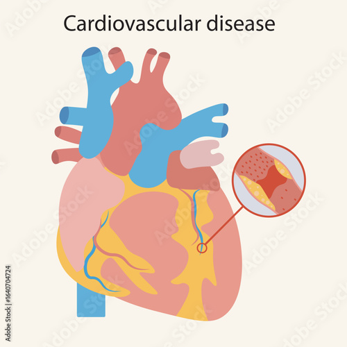 Flat vector illustration on cardiovascular disease, heart icon highlighting key symptoms like chest pain, fatigue, breathlessness, and showing related conditions such as stroke and hypertension.