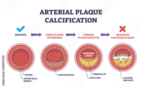 Arterial plaque calcification shows artery cross-sections with plaque buildup, narrowed lumen, and calcium deposits. Outline diagram