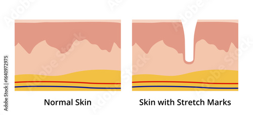 Normal skin versus skin with stretch marks