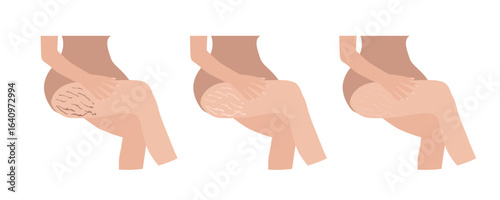 Woman checking stretch marks on her legs, showing different stages of healing
