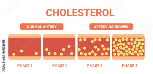 Cholesterol in artery, health risk , vector design