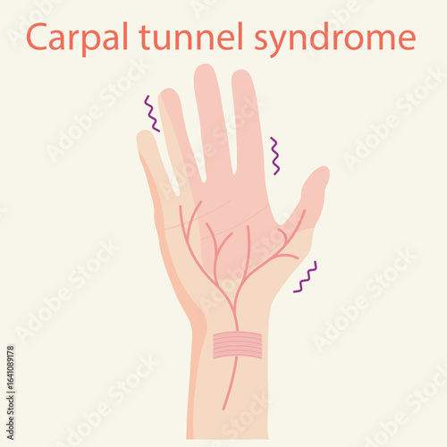 Medical vector illustration of carpal tunnel syndrome showing hand pain, numbness, tingling, and weakness. Includes related disorders like arthritis and tendonitis.
