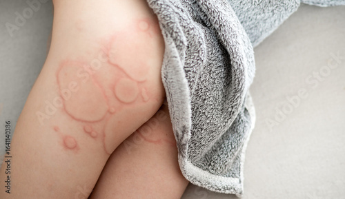 Preschool kid with severe hives on buttocks and hip, child lying on a bed under a blanket. Large and small red swollen spots caused by allergic reaction to food or chemical products.