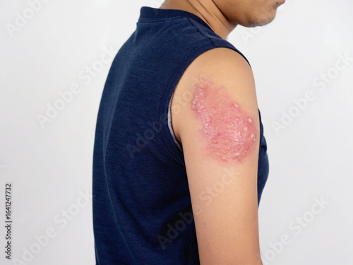 Shingles rash on the arm of a man isolated on white background