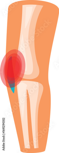 Medical illustration showing elbow bones and ligaments experiencing pain