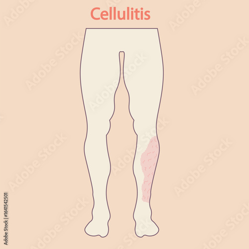 Flat vector illustration of cellulitis showing red, swollen, tender skin with fever. Includes symptoms and related conditions like erysipelas and abscess. leg