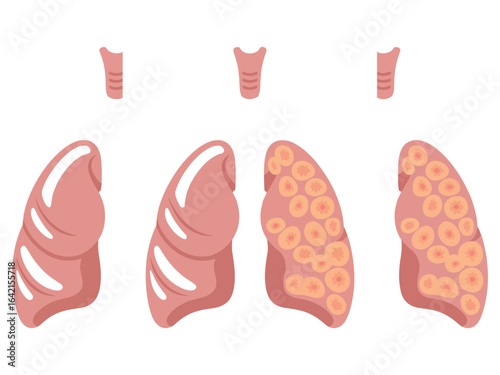Medical Diagram of Lung Cancer Stages Showing Healthy and Cancerous Lungs, Oncology Illustration