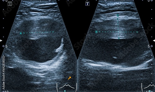 Ultrasound scan of a patient's abdominal aorta aneurysm 
