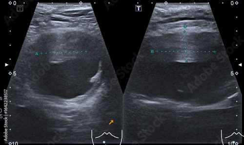Ultrasound scan of a patient's abdominal aorta aneurysm 
