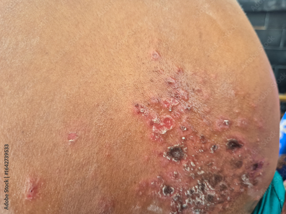 Fototapeta premium Close up image of skin texture suffering severe urticaria or hives or kaligata in shoulder asian girl. Allergy symptoms, with wounds that partially dry out from eating seafood.
