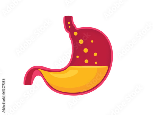 Stomach with gastroesophageal Reflux Disease