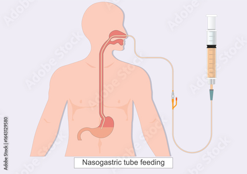 Nasogastric tube feeding (NG) is a thin flexible tube