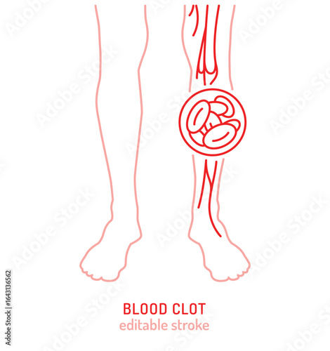 Blood clot in leg vein vector icon, medical pictogram for vascular disease awareness
