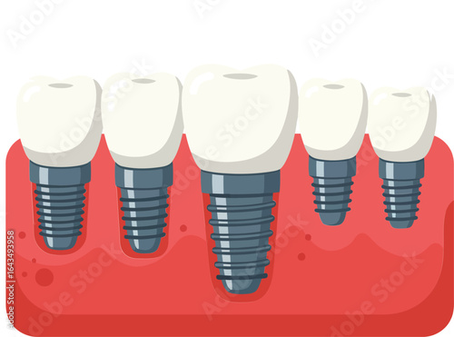 Dental implants with titanium screws inserted into pink gum vector illustration for oral health and dentistry concept