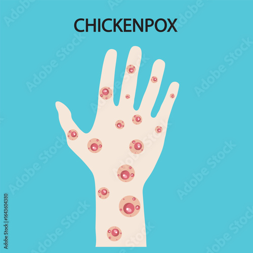Flat vector illustration of hand chickenpox showing symptoms like rash, blisters, fever, with comparisons to measles and shingles in a clear medical style.