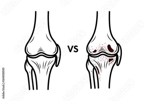 comparison illustration of healthy knee joint vs. arthritic knee joint for medical education