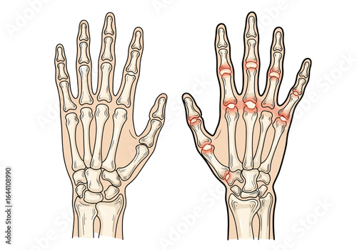 illustration of hands displaying arthritis with highlighted joints for medical reference and education