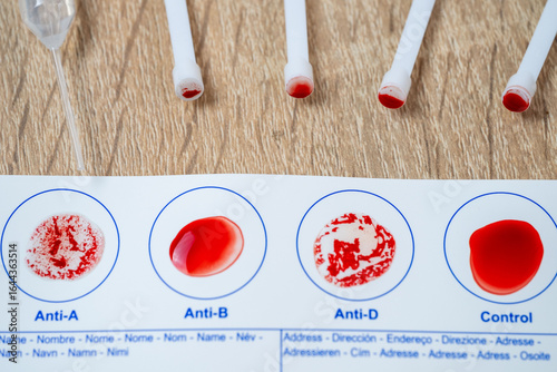 Quadro su tela Blood typing test card with Anti-A, Anti-B, Anti-D result, diagnostics and healt