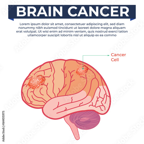Understanding Brain Cancer Diagnosis and Survival Rates