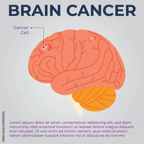 Early Signs of Brain Cancer and How to Prevent It