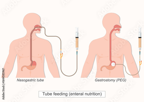 Tube feeding (enteral nutrition).