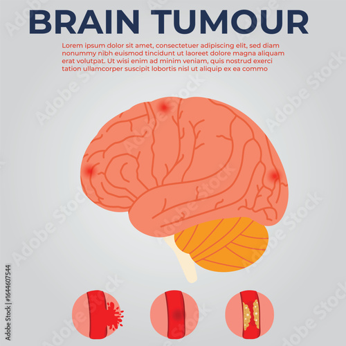 Early Signs of Brain Tumour Diagnosis and Prevention Tips