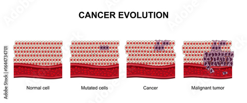 cancer evolution from mutated normal cells to malignant tumors, hyperplasia and dysplasia. The spread of cancer cells. Medical vector illustration, poster or science study.