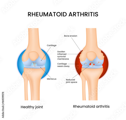 Rheumatoid Arthritis Comparison of Healthy and Affected Knee Joints