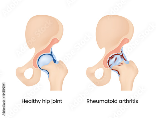 Healthy Hip Joint vs Rheumatoid Arthritis Medical Illustration
