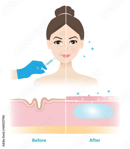 Comparison of before and after dermal filler injection on woman face illustration. Cross section of wrinkles skin and filler injected to correct the lines and wrinkles. Medical and beauty concept.