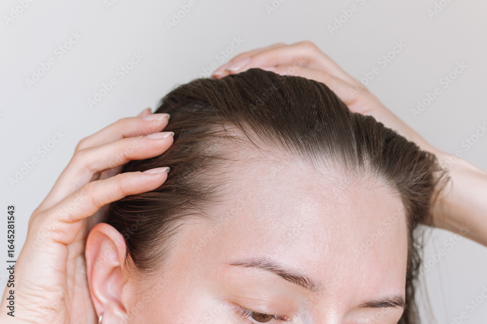 Fototapeta premium Young brunette woman suffering from hair loss showing her hair in the temple area with both hands. Woman's health. Baldness, the effects of the disease, lack of vitamins.