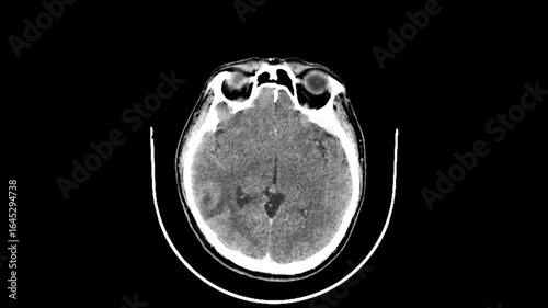 Brain tumor CT scan video
