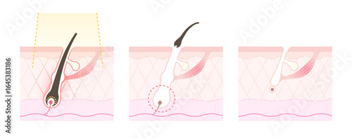 脱毛のイメージ、美容脱毛・光脱毛のしくみのイラスト