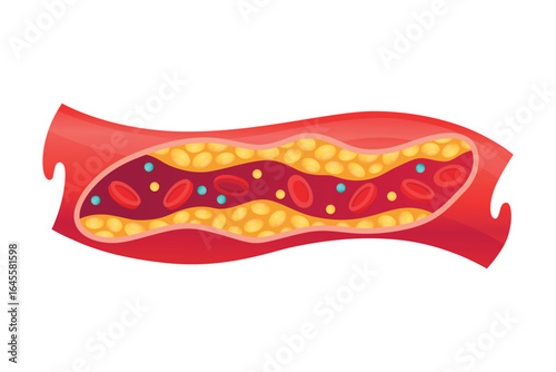 Type of cholesterol in human blood vessels. Narrowed artery for explanation diseases. Low-Density Lipoprotein LDL . Vector illustration