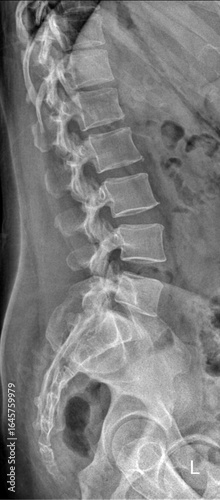 lumbar spine X-ray showing vertebrae L1 to L5. It's typically used to assess spinal alignment, disc spacing, and detect abnormalities like fractures, disc degeneration, or scoliosis.