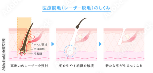 脱毛のイメージ、医療脱毛・レーザー脱毛のしくみ