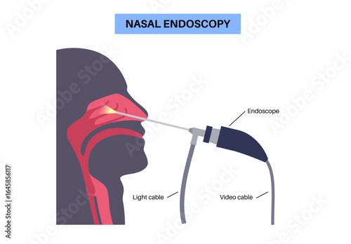 Nasal endoscopy poster