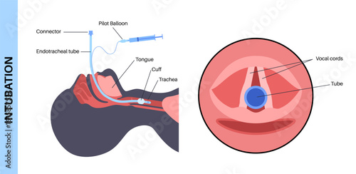 Intubation medical procedure