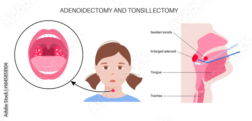 Adenoidectomy medical procedure
