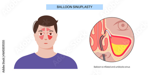 Balloon sinuplasty poster