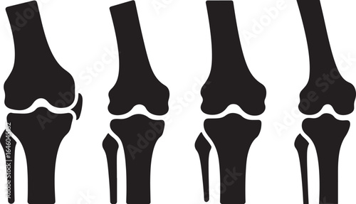 Four stages of knee joint degeneration and osteoarthritis progression silhouette