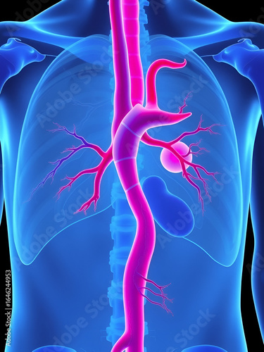 left aorta root bulge of Turner Marfan Syndrome chest disorder heart attack stroke graft for aortic arch pain with hernia high blood vessel clots and stent dilated open renal vein kidney damage