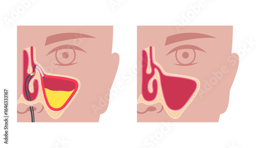 Balloon sinuplasty poster