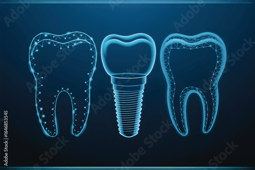  A digital illustration of dental implants and teeth rendered in a glowing neon blue wireframe style